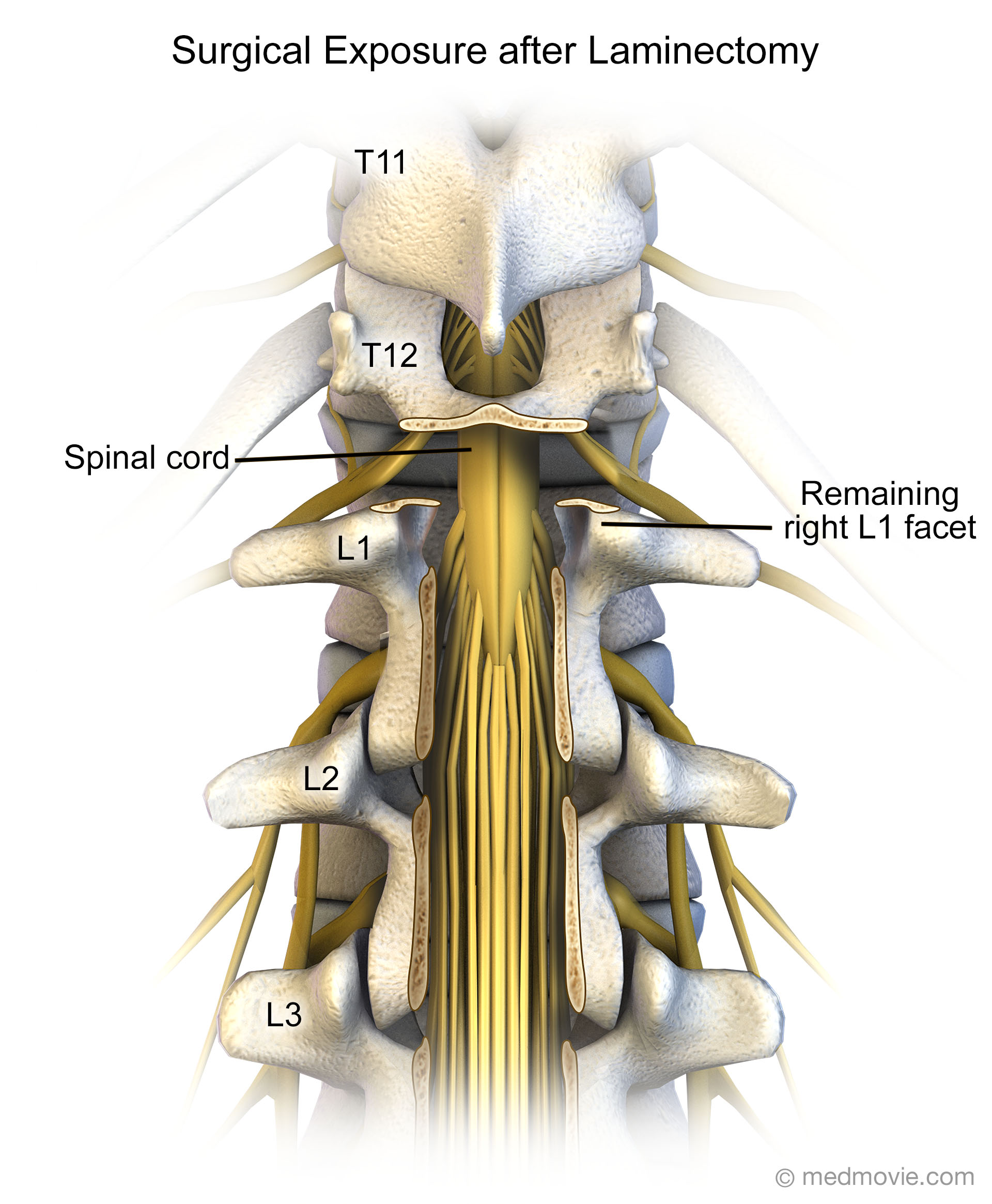 laminectomy