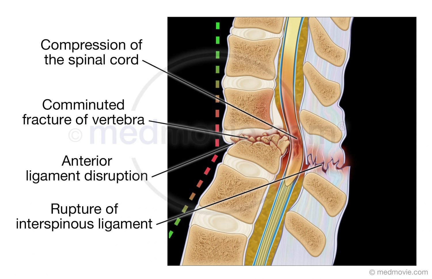 Vertebral Fracture Cross Section – Medmovie.com