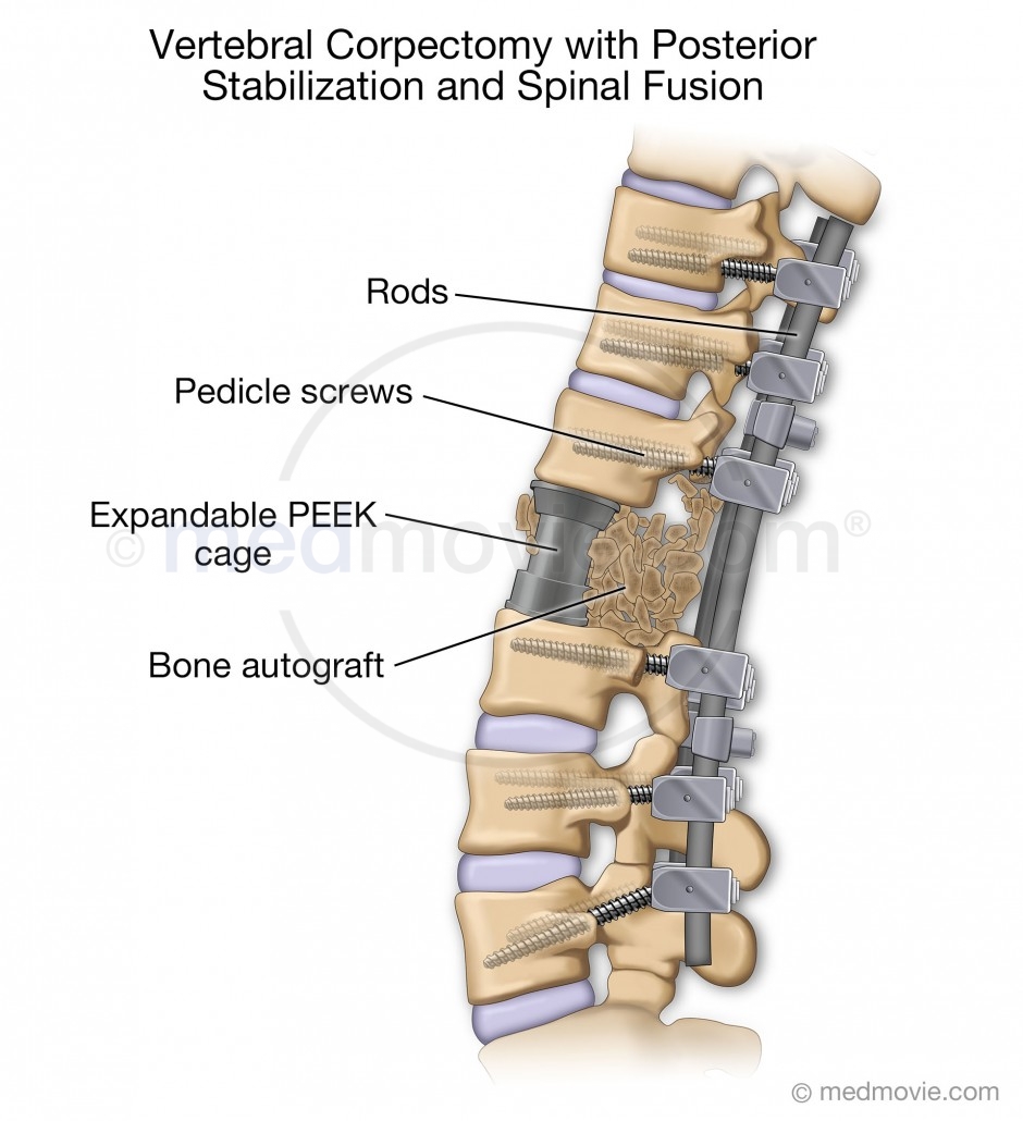 Posterior Spine Stabilization