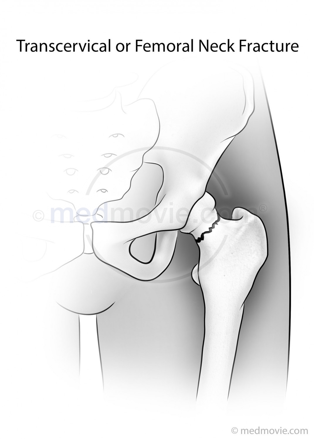 right femoral intertrochanteric fracture icd 10