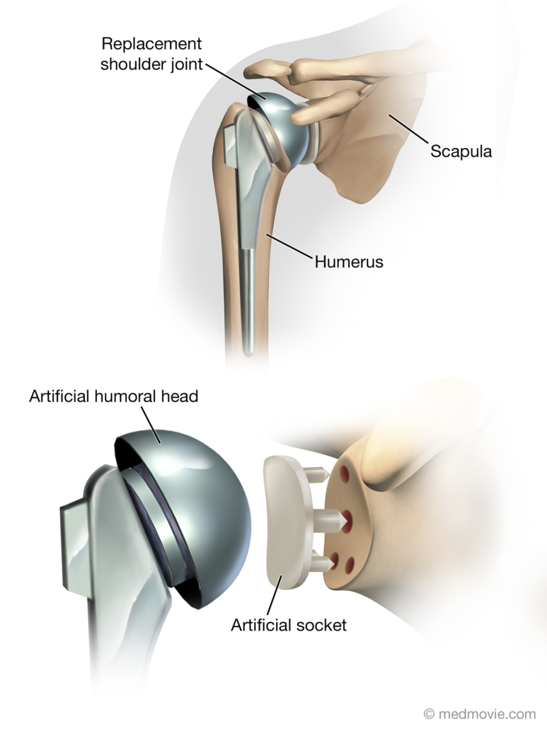 Standard shoulder joint replacement with zoom in