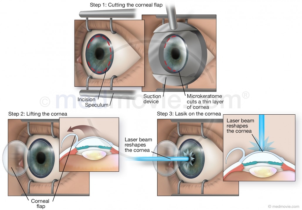 LASIK