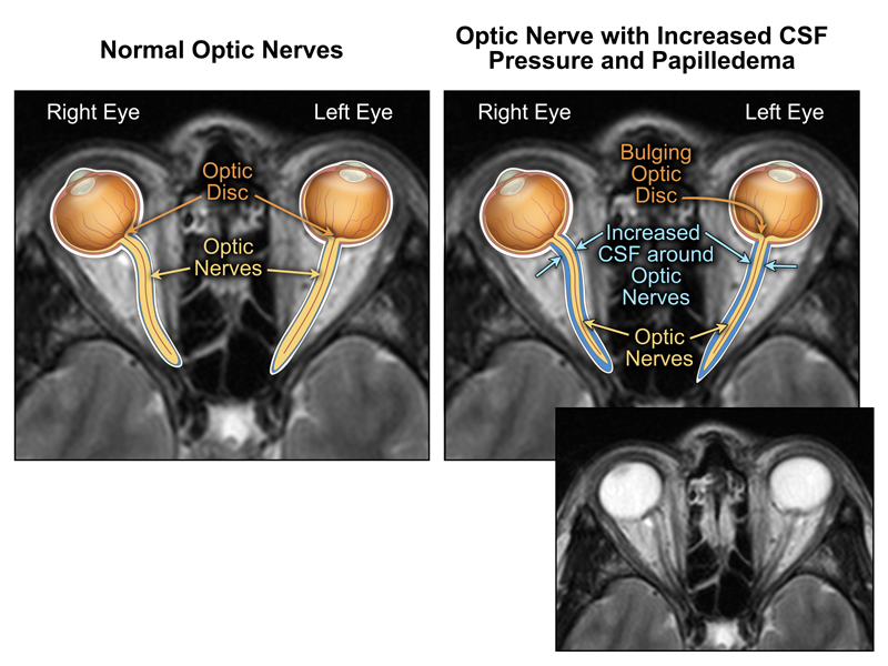 normal optic nerve mri